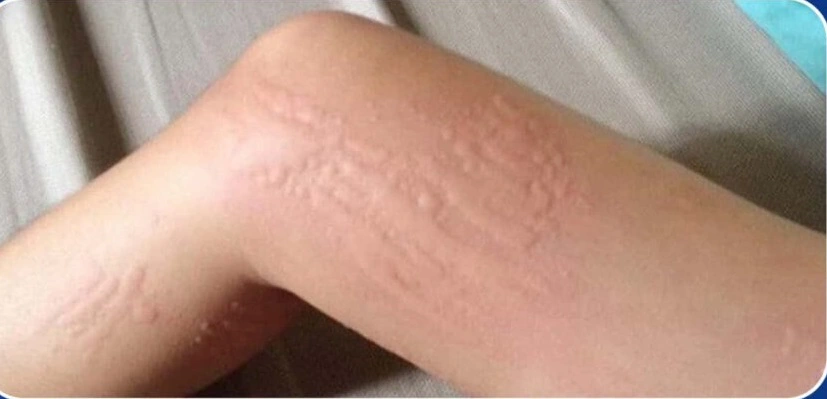 Nổi mề đay do lạnh cần làm gì?